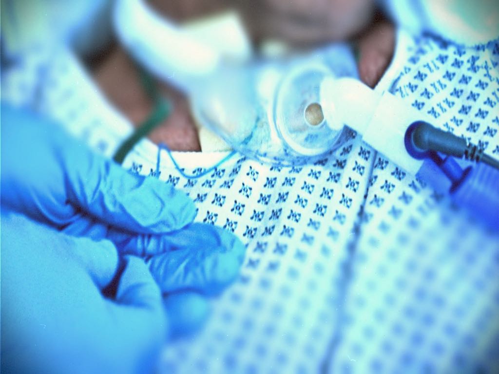 Picture of a patient with a tracheostomy